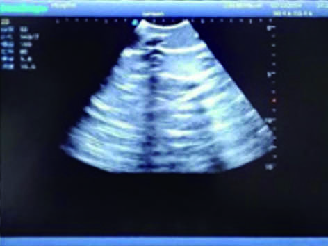 Pneumothorax & Thoracic Closed Drainage Ultrasound Training Model