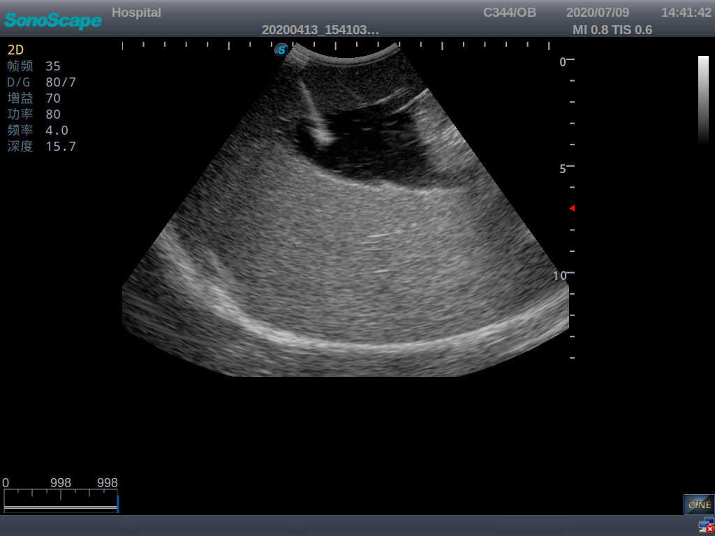 Amniocentesis Ultrasound Trainer