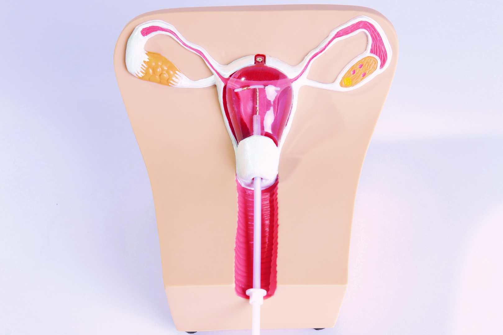 IUD Insertion Model I